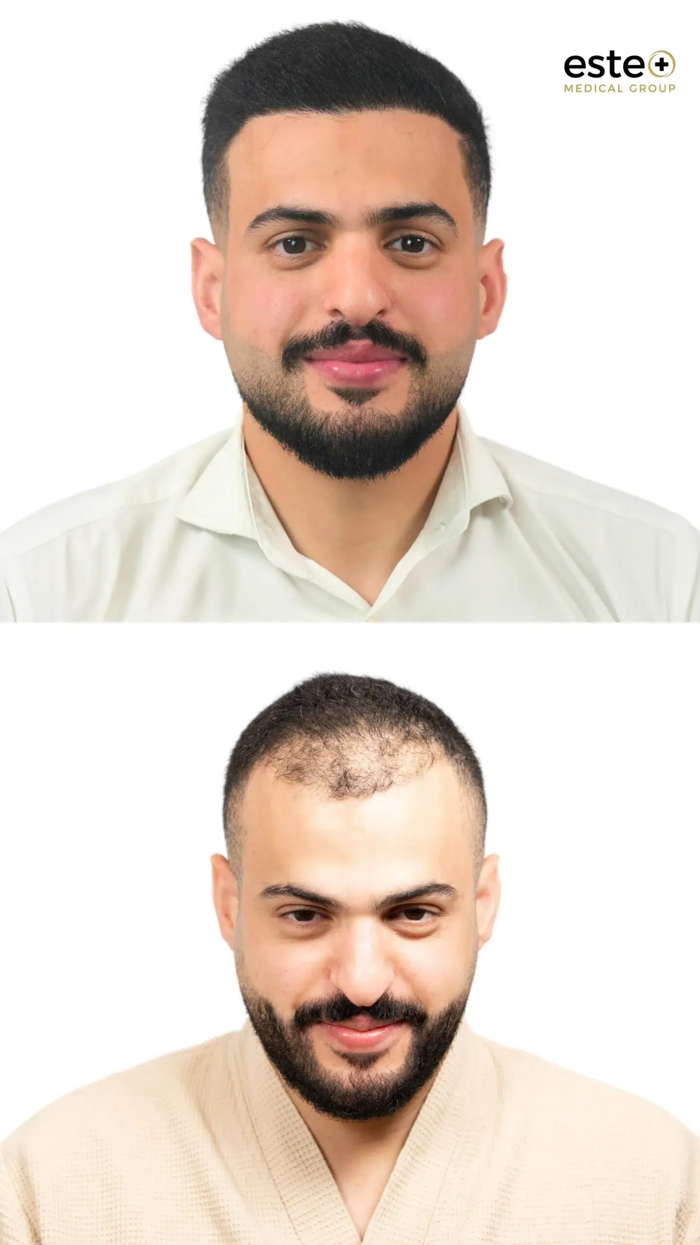 Robotic DHI hair transplant before and after results