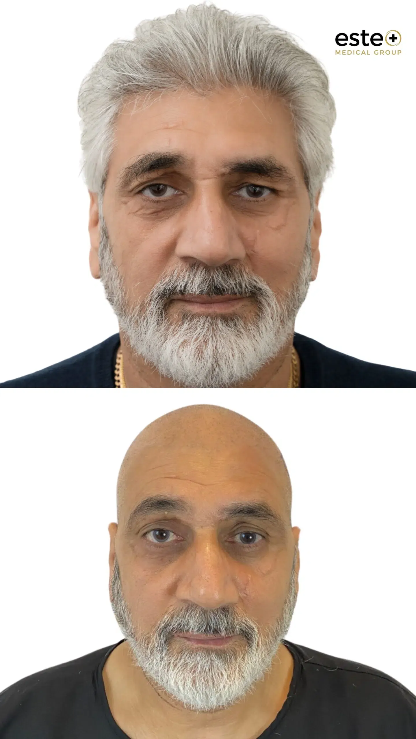 Hair transplant before and after photos (UK results)