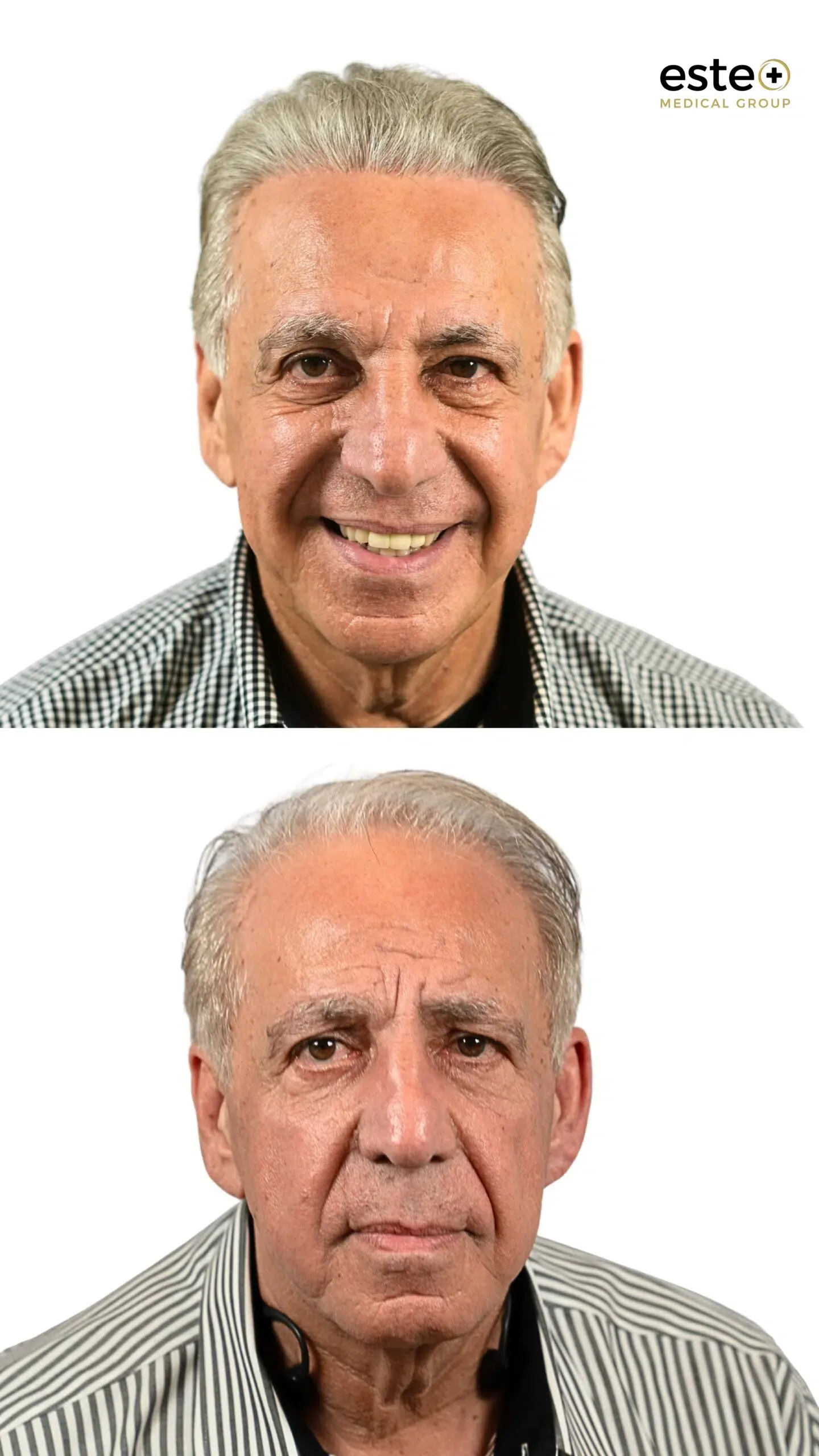 Hair transplant before and after results (visible regrowth)