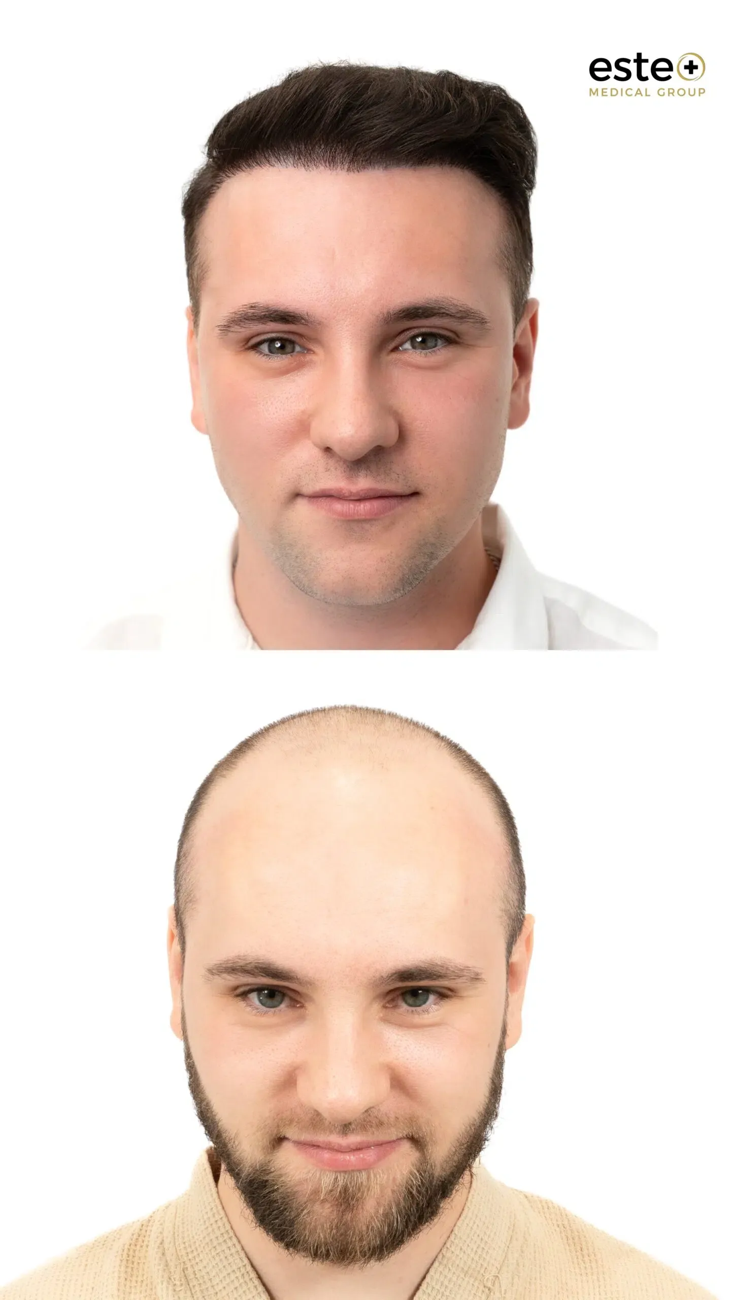 Hair transplant before and after results for thinning hair