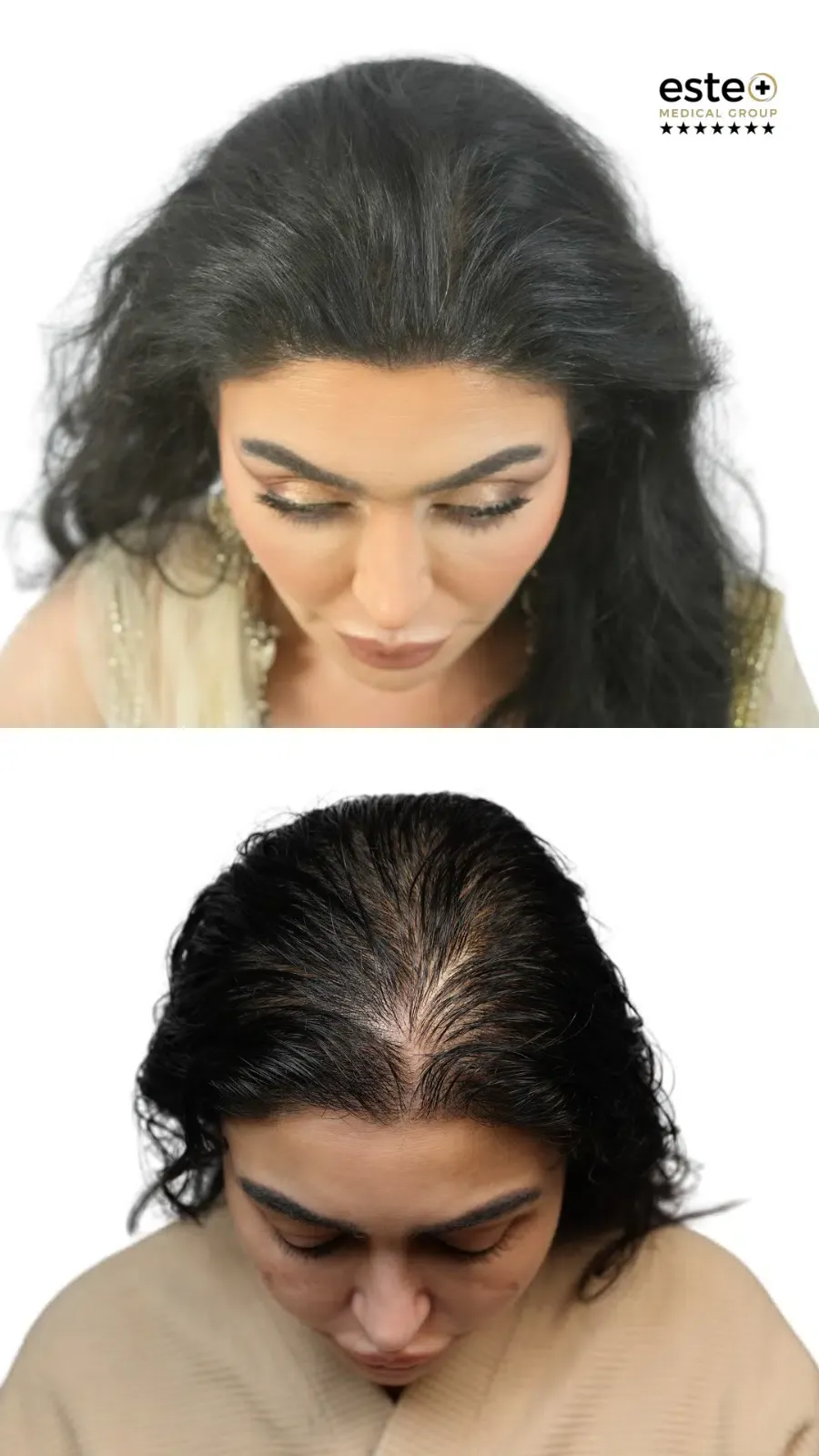 Hair transplant before and after photos (UK results)